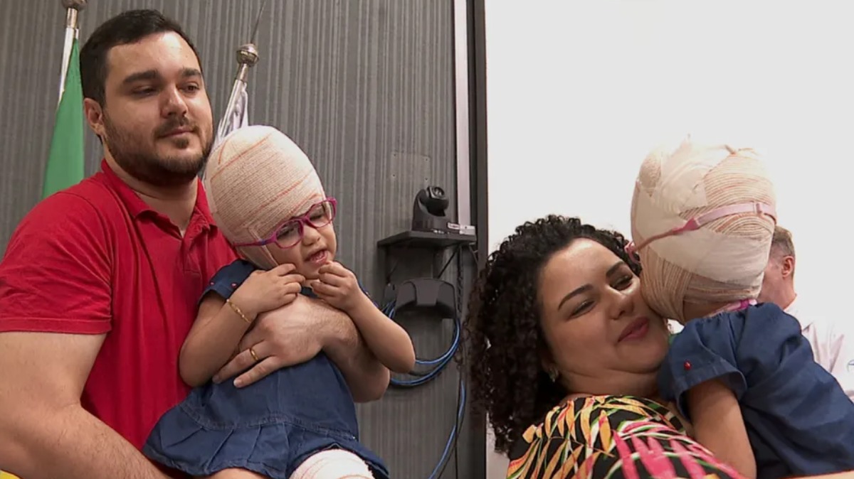 Separação de gêmeas siamesas realizada