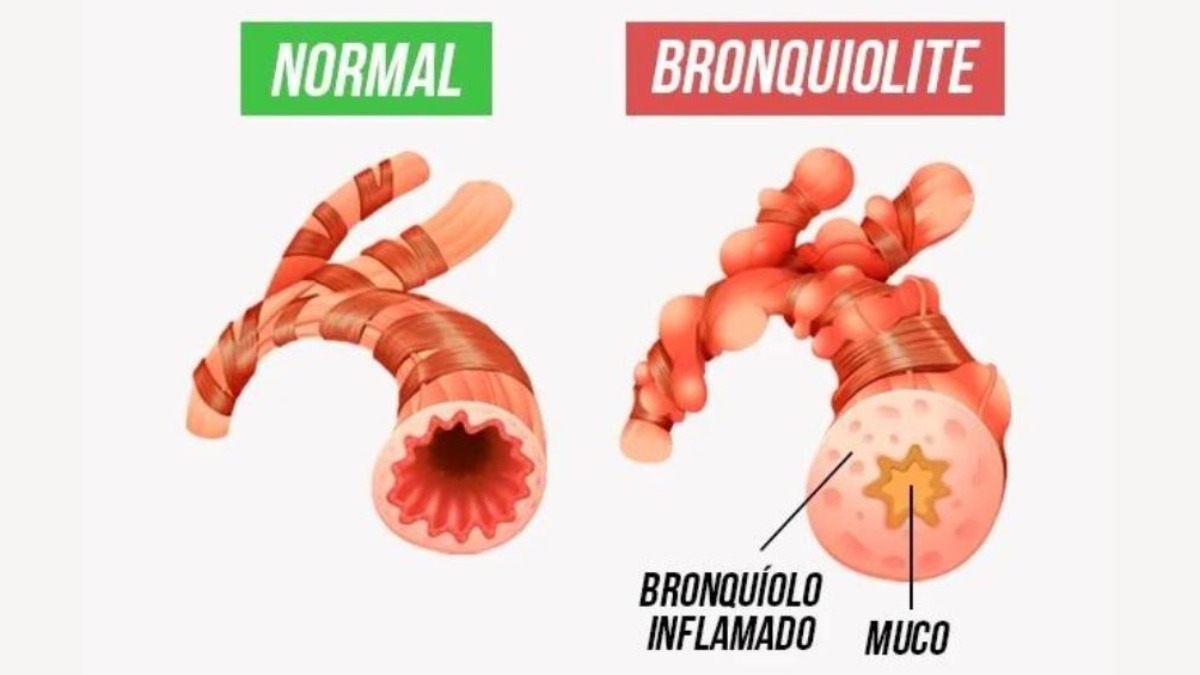 bronquiolite em crianças