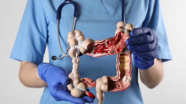 atividade física e câncer de cólon