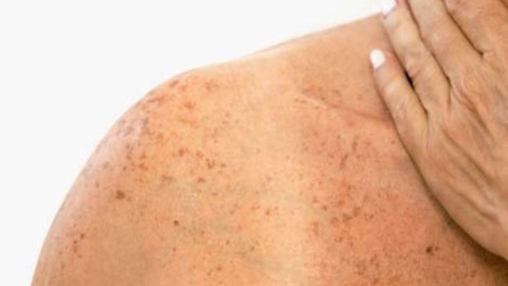 Aumento da temperatura e exposição ao