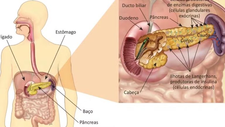 Câncer de pâncreas