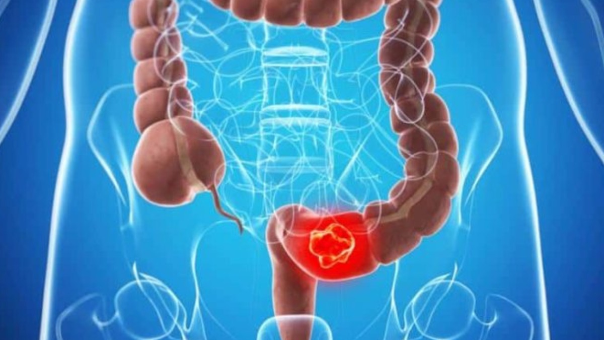 câncer de intestino