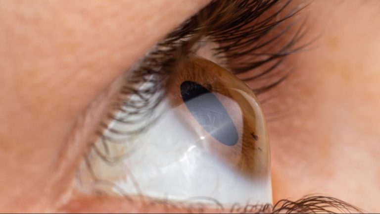 ceratocone aumento casos são paulo