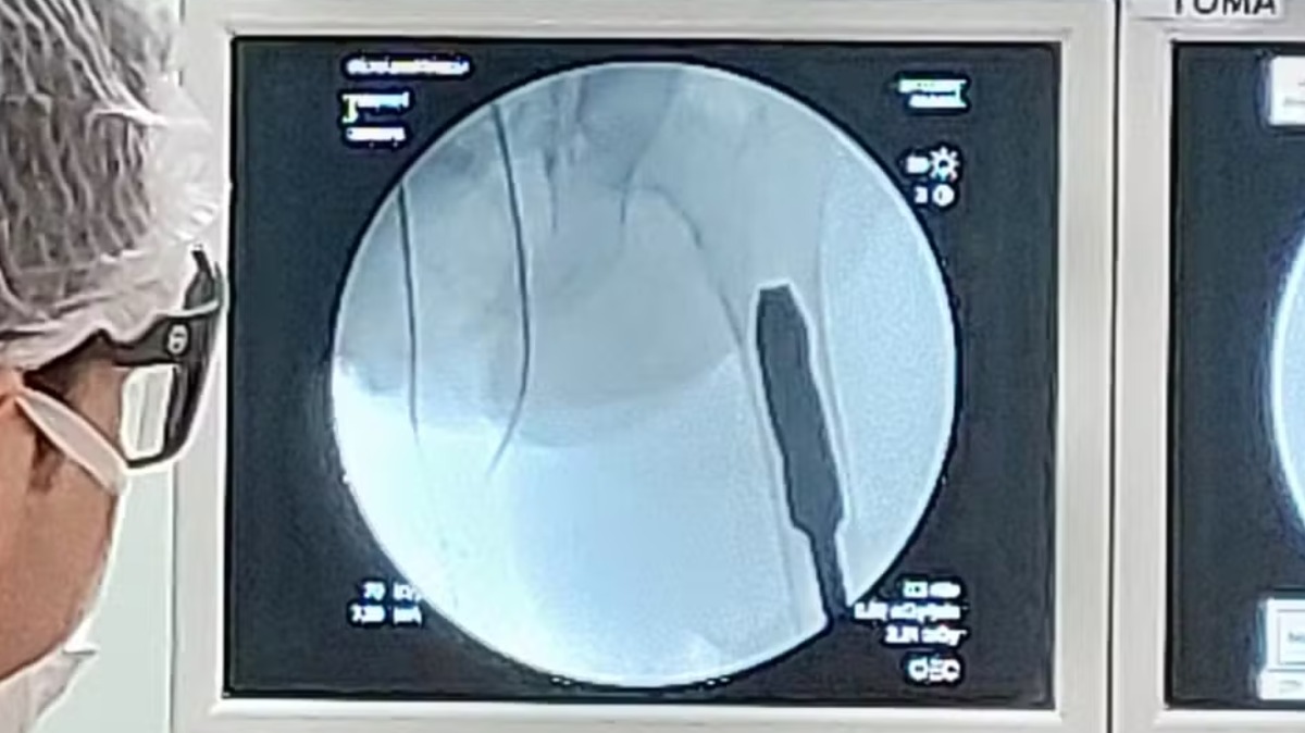 cirurgias de osteointegração