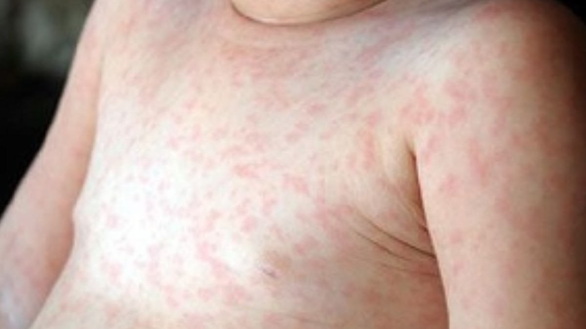 Roséola e mão-pé-boca