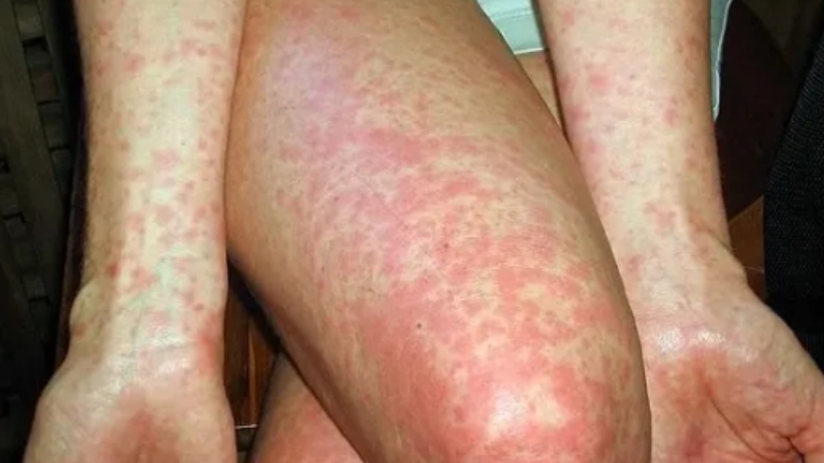 pneumonia em crianças