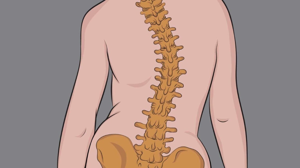 escoliose