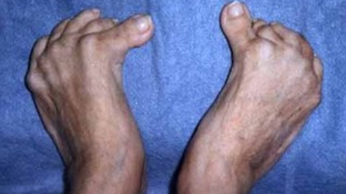 Osteoporose e fraturas