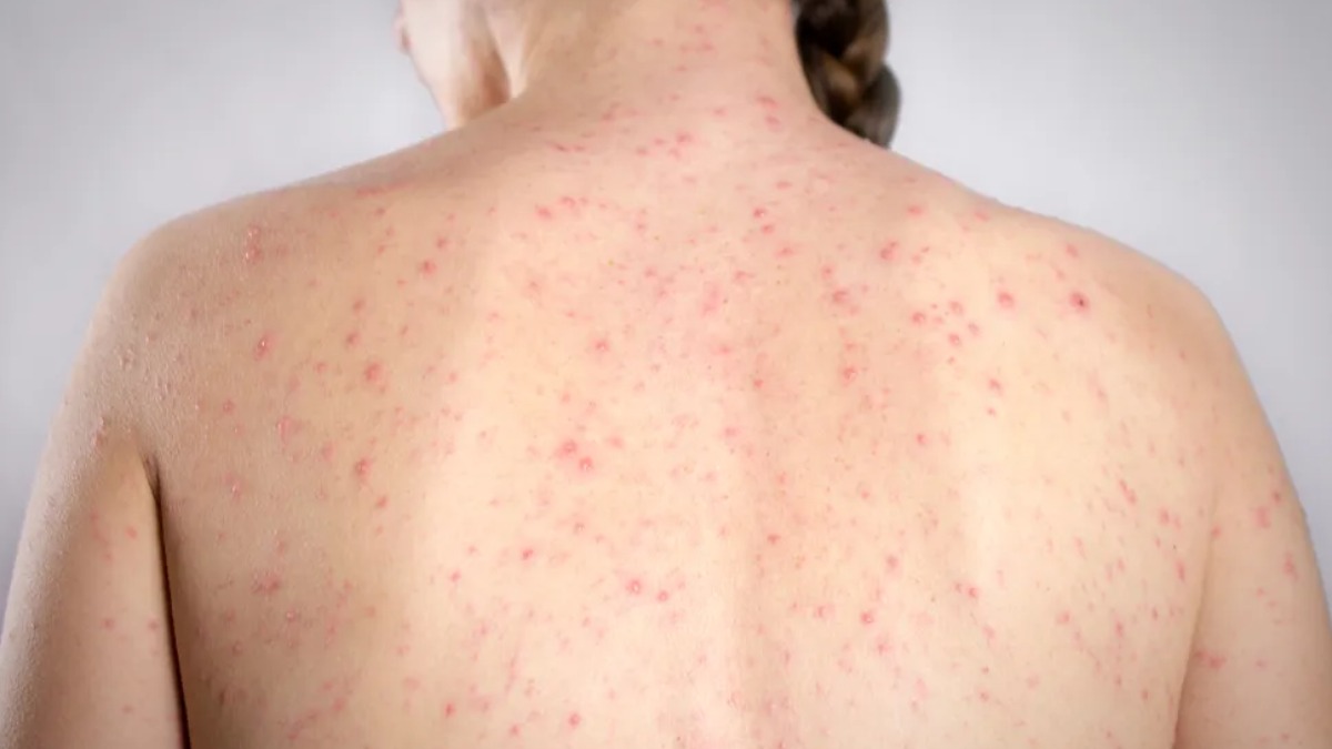 surto doença creches