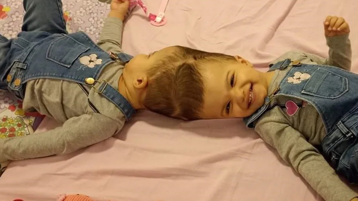 cirurgia separação gêmeas