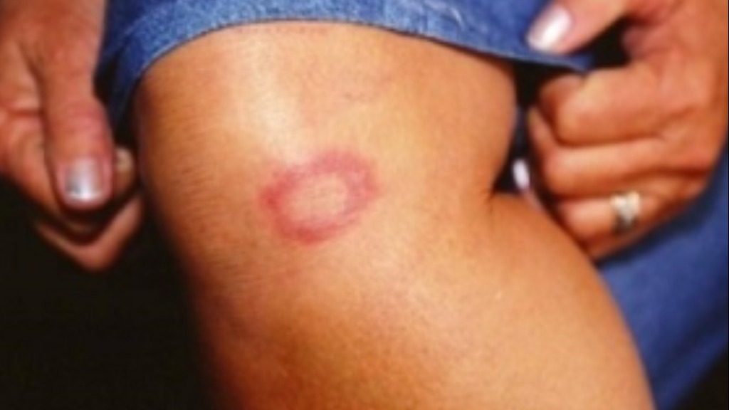 casos de hanseníase