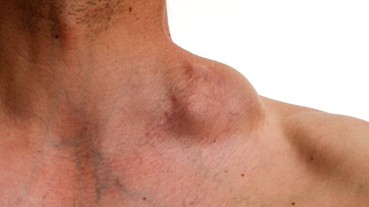 linfoma não Hodgkin