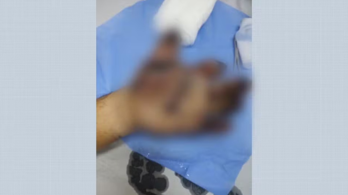 Pintor perde dedos da mão após