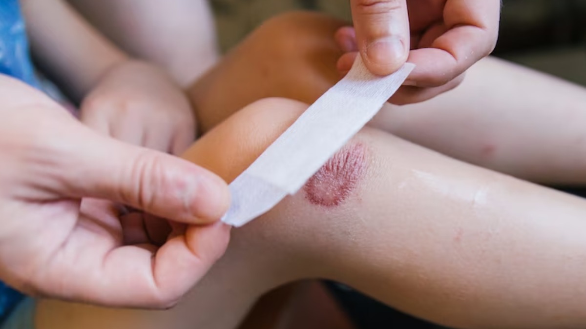 queimaduras em crianças