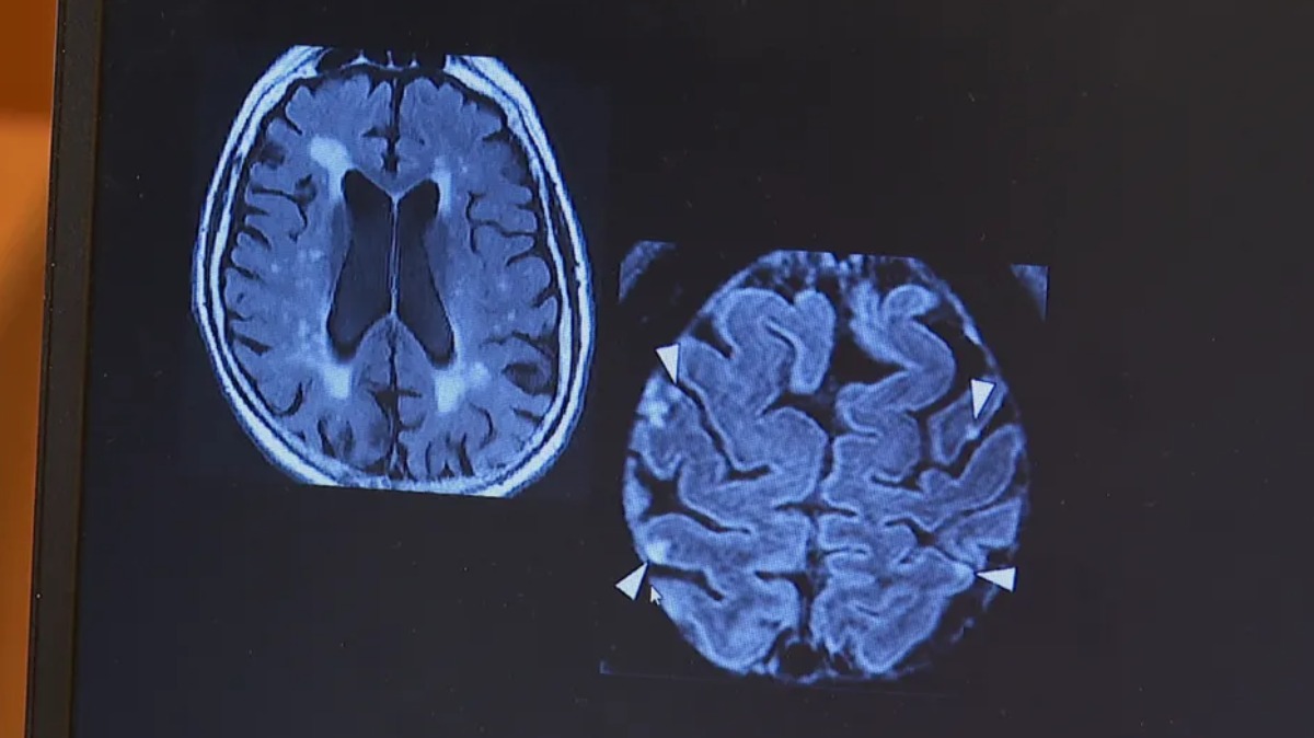 lesões cerebrais idosos