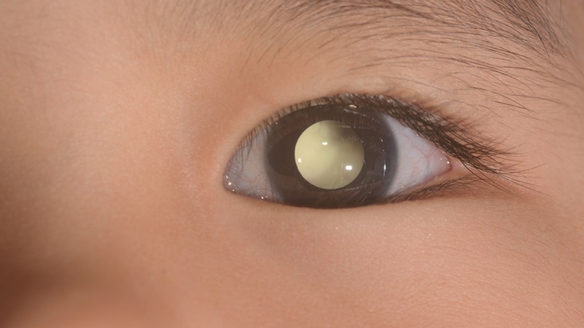 retinoblastoma