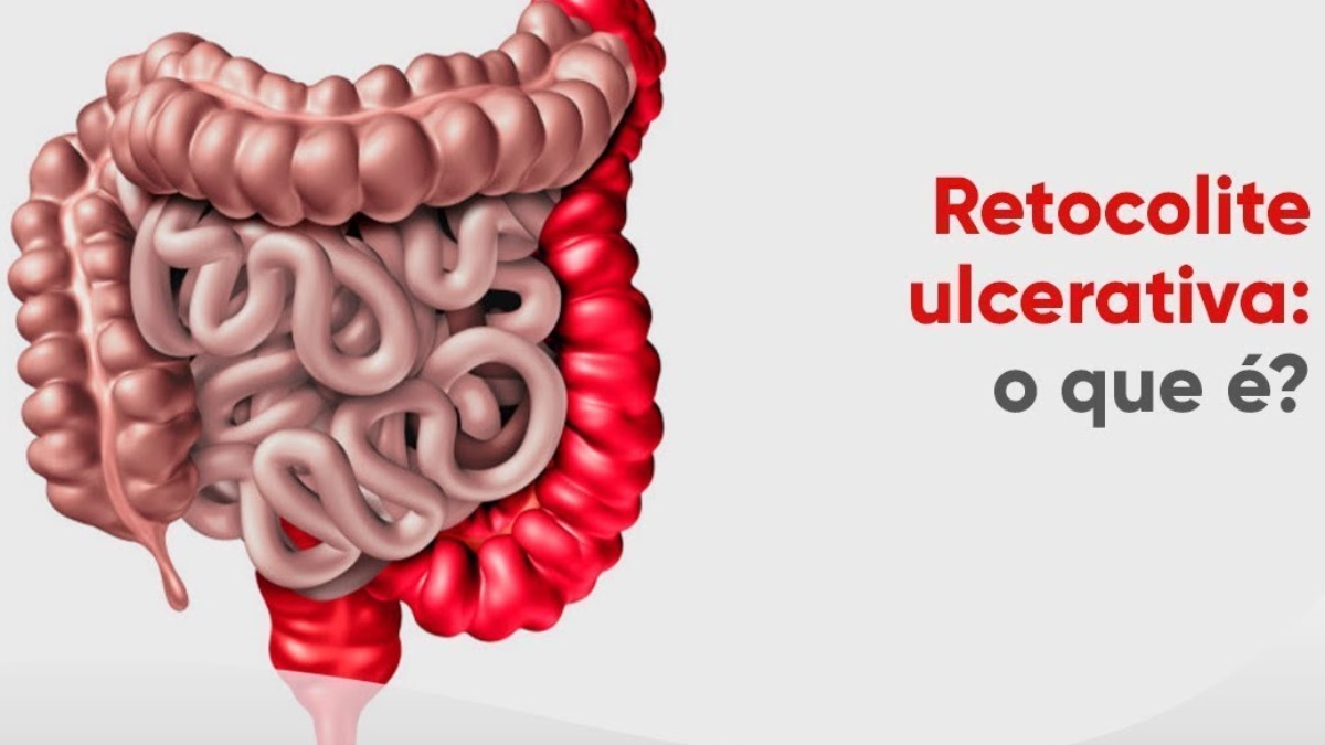 doença inflamatória intestino