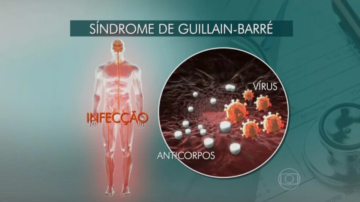 Síndrome de Guillain Barré