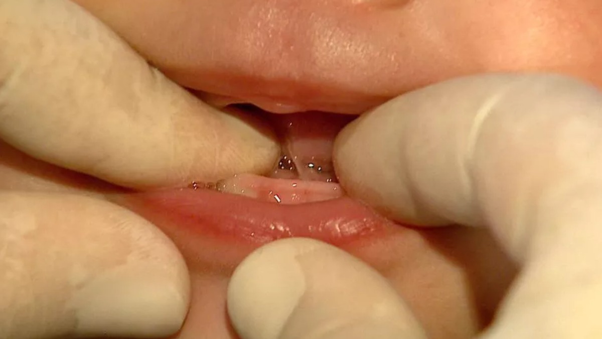 teste da linguinha recém-nascidos