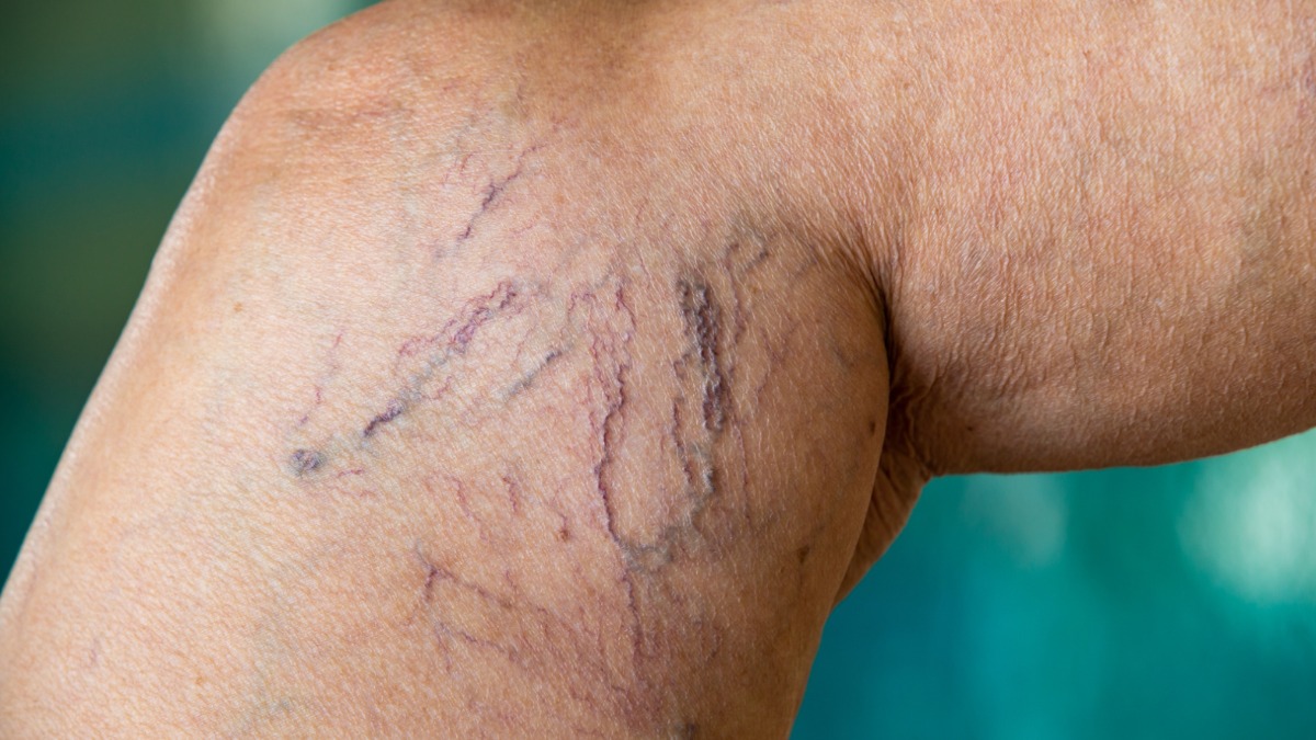 varizes altas temperaturas