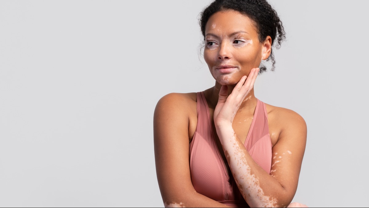 Dia Nacional Vitiligo