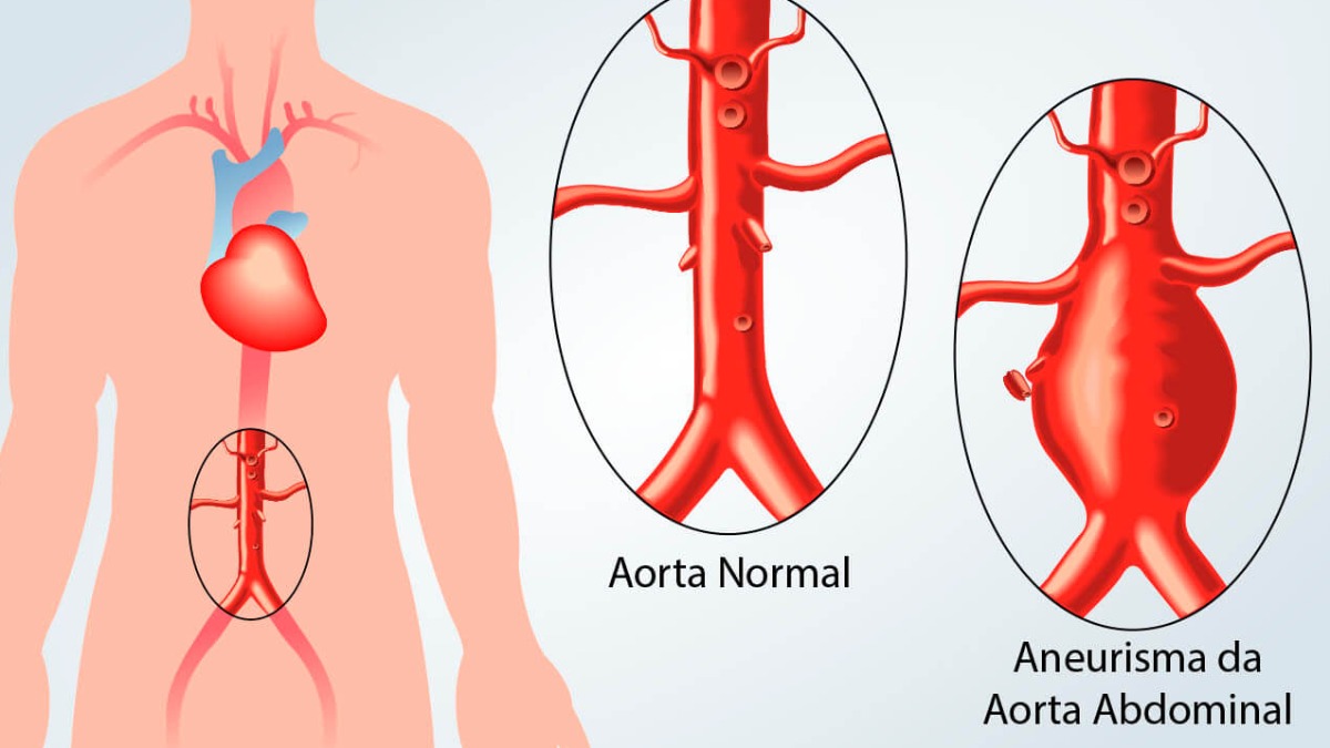 enzimas aorta abdominal