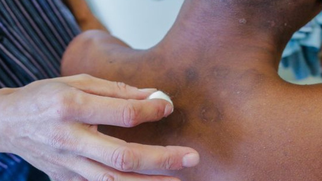 diagnóstico hanseníase