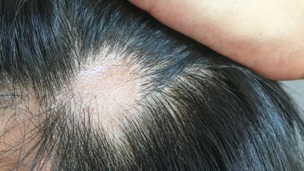 queda de cabelo sono