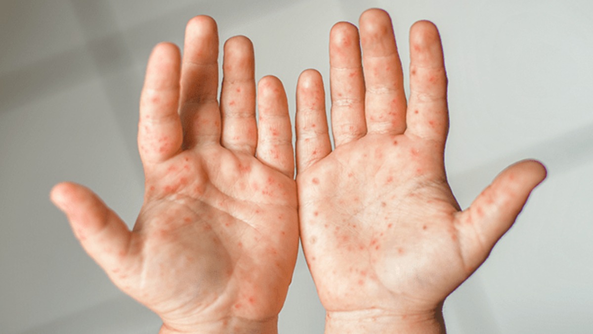 Síndrome Mão-Pé-Boca