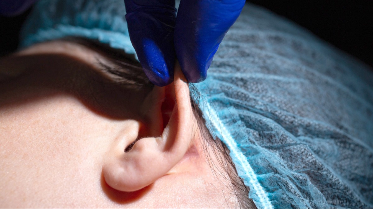 otoplastia para orelhas de abano