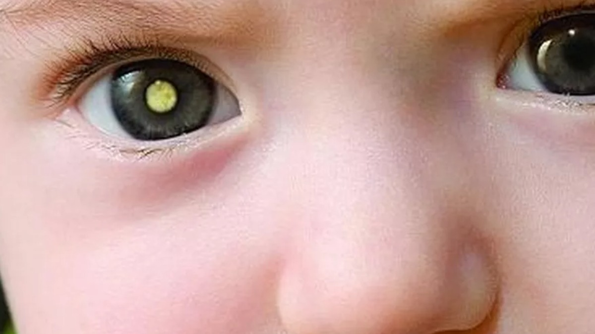 retinoblastoma doença infantil