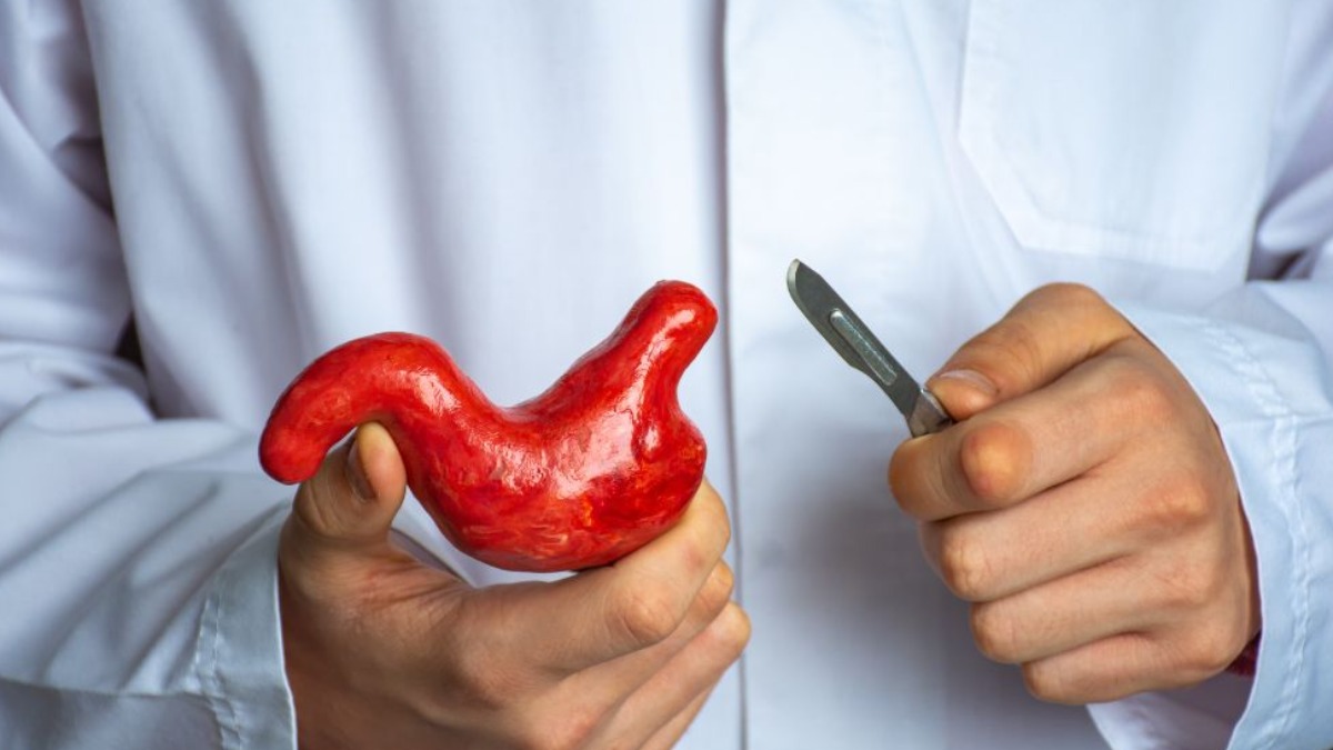 Gastroplastia endoscópica