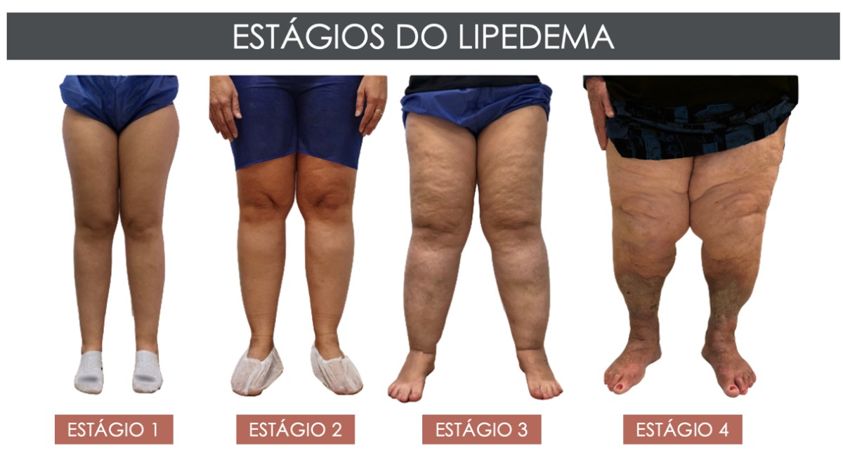 Lipedema qualidade de vida