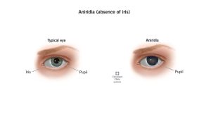 Aniridia doença rara