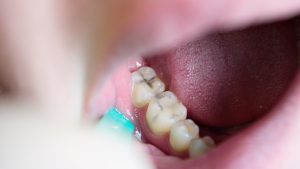 Cárie dentes saúde bucal